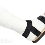 Broken-Sprained-Foot-Leg-Ankle-Cast-Boot