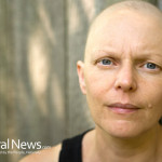Cancer-Woman-Bald-Chemotherapy-Sick