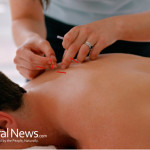 Woman-Practicing-Acupuncture